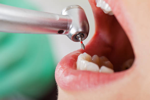 Best Emergency Dental Care for Broken or Chipped Teeth in South Amherst, OH